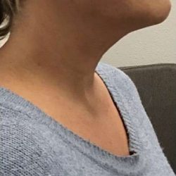 Thread Lifts Before & After Patient #247