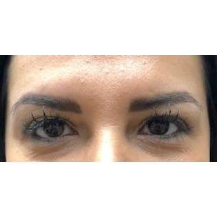 Botox Before & After Patient #180