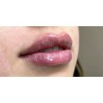 Lip Augmentation Before & After Patient #244