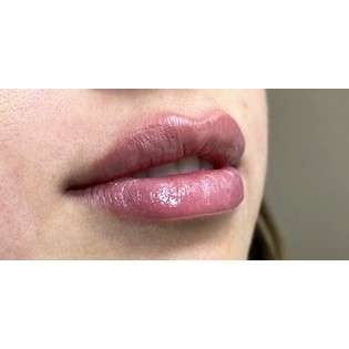 Lip Augmentation Before & After Patient #244