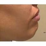 Jawline Chin Enhancement Before & After Patient #188