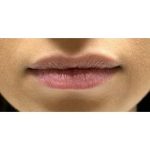 Lip Augmentation Before & After Patient #244