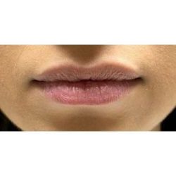 Lip Augmentation Before & After Patient #244