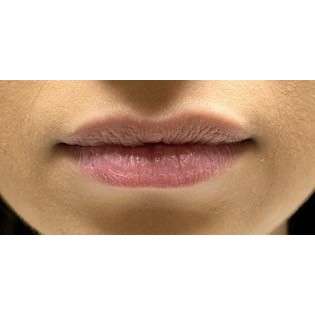 Lip Augmentation Before & After Patient #244