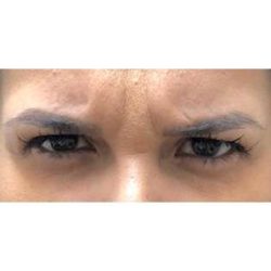 Botox Before & After Patient #180