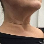 Thread Lifts Before & After Patient #247