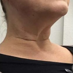 Thread Lifts Before & After Patient #247