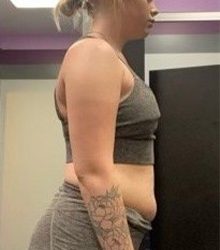 Weight Loss Before & After Patient #266