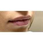 Lip Augmentation Before & After Patient #244