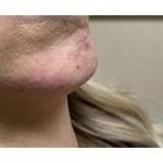 Jawline Chin Enhancement Before & After Patient #185