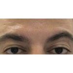 Botox Before & After Patient #177