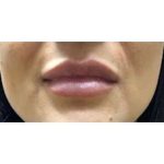 Lip Augmentation Before & After Patient #216