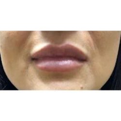 Lip Augmentation Before & After Patient #216