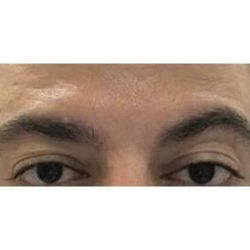 Botox Before & After Patient #177