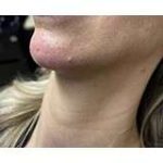 Jawline Chin Enhancement Before & After Patient #185