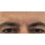 Botox Before & After Patient #177