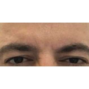 Botox Before & After Patient #177