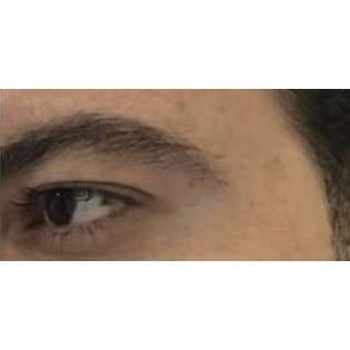 Botox Before & After Patient #177