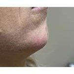Jawline Chin Enhancement Before & After Patient #185