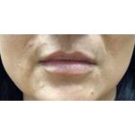 Lip Augmentation Before & After Patient #216