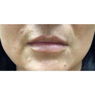 Lip Augmentation Before & After Patient #216
