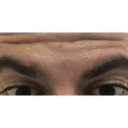 Botox Before & After Patient #177