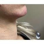 Jawline Chin Enhancement Before & After Patient #185