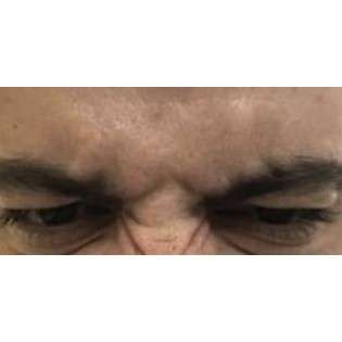 Botox Before & After Patient #177