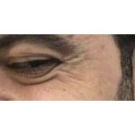 Botox Before & After Patient #177