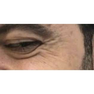 Botox Before & After Patient #177