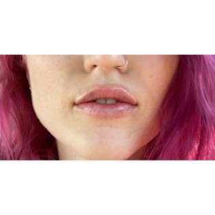 Lip Augmentation Before & After Patient #213