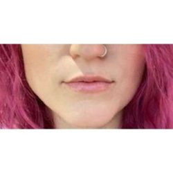 Lip Augmentation Before & After Patient #213
