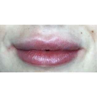 Lip Augmentation Before & After Patient #210