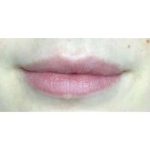 Lip Augmentation Before & After Patient #210