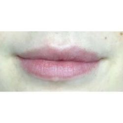 Lip Augmentation Before & After Patient #210