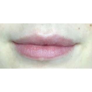 Lip Augmentation Before & After Patient #210