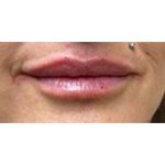 Lip Augmentation Before & After Patient #207