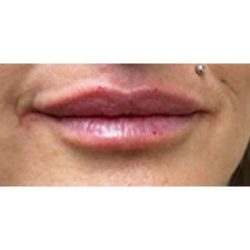 Lip Augmentation Before & After Patient #207