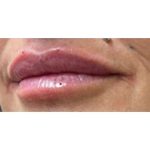 Lip Augmentation Before & After Patient #207
