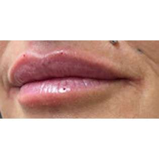 Lip Augmentation Before & After Patient #207