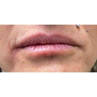 Lip Augmentation Before & After Patient #207