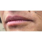 Lip Augmentation Before & After Patient #207