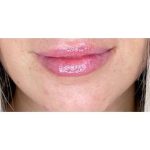 Lip Augmentation Before & After Patient #202