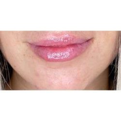Lip Augmentation Before & After Patient #202