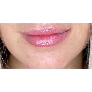 Lip Augmentation Before & After Patient #202