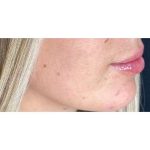 Lip Augmentation Before & After Patient #202