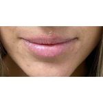 Lip Augmentation Before & After Patient #202