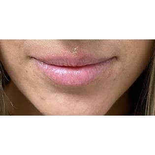 Lip Augmentation Before & After Patient #202