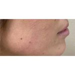 Lip Augmentation Before & After Patient #202