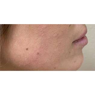 Lip Augmentation Before & After Patient #202